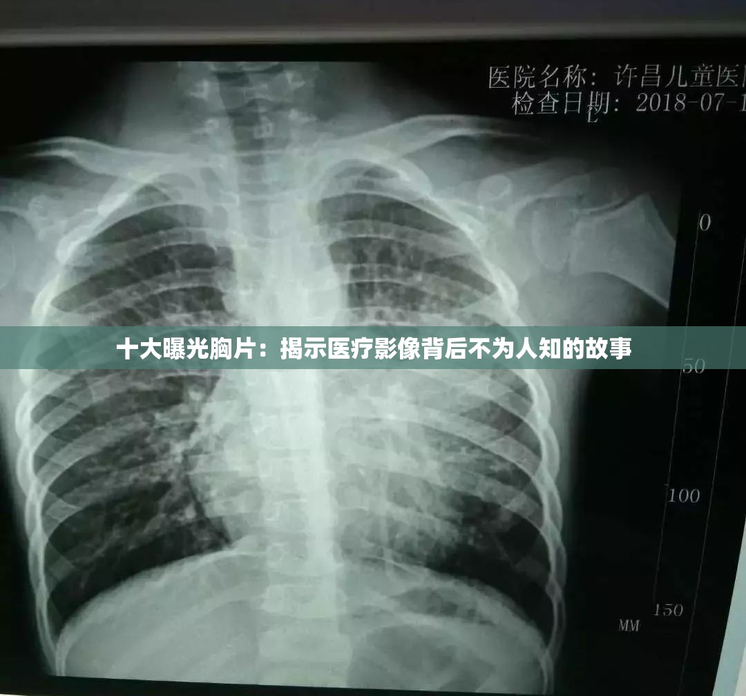 十大曝光胸片：揭示医疗影像背后不为人知的故事