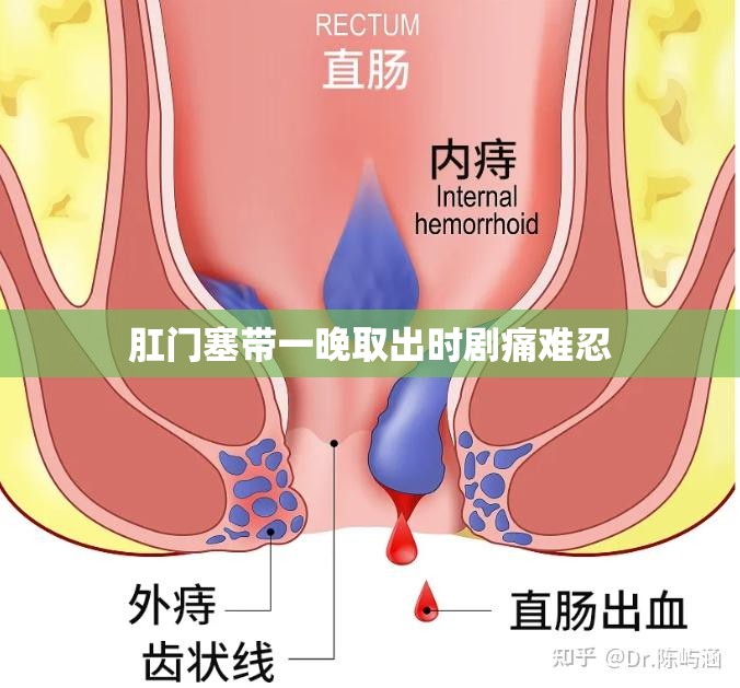 肛门塞带一晚取出时剧痛难忍