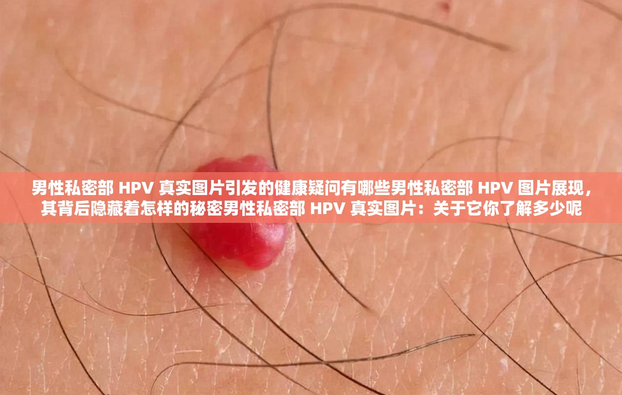 男性私密部 HPV 真实图片引发的健康疑问有哪些男性私密部 HPV 图片展现，其背后隐藏着怎样的秘密男性私密部 HPV 真实图片：关于它你了解多少呢